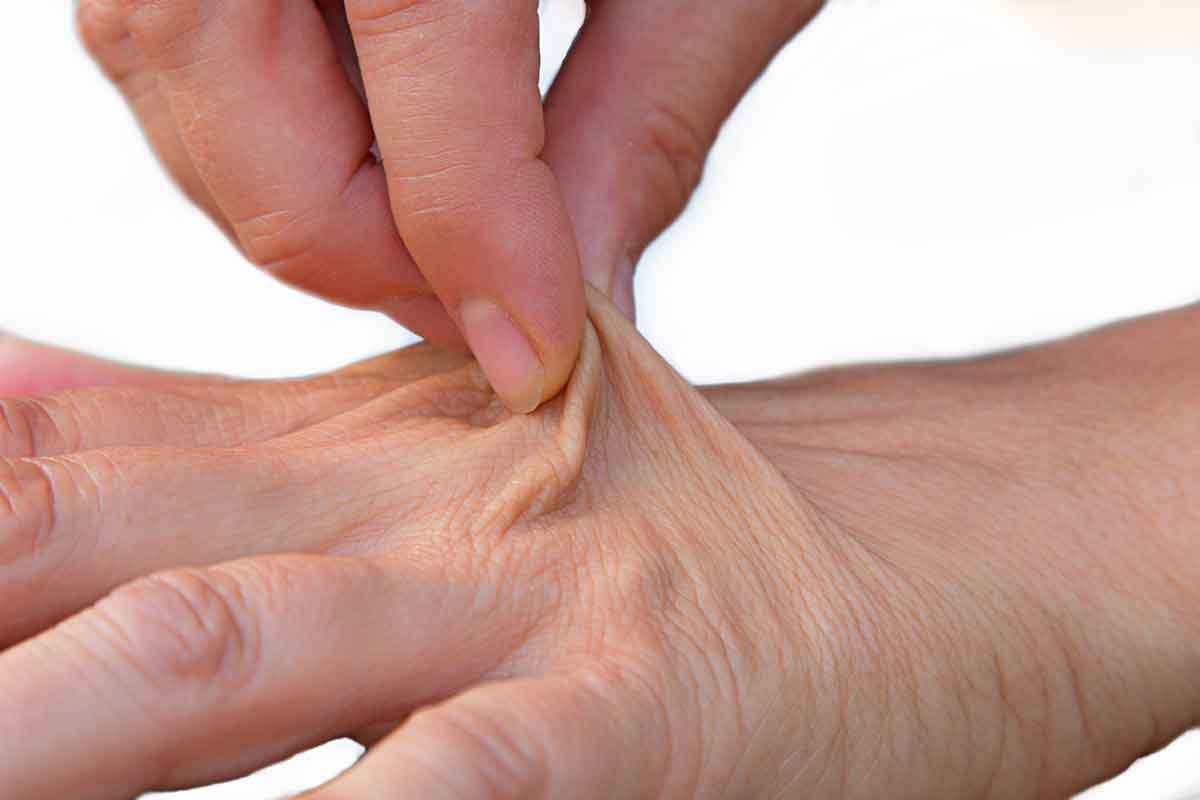 pinching dehydrated skin